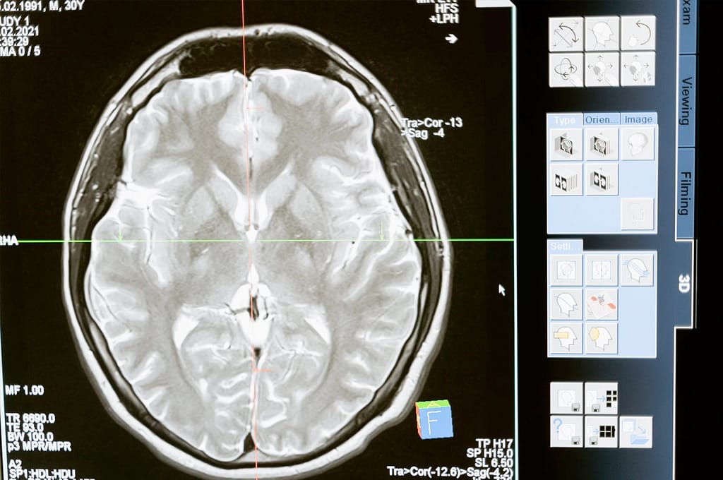 Como melhorar os resultados da radioterapia com menos efeitos colaterais