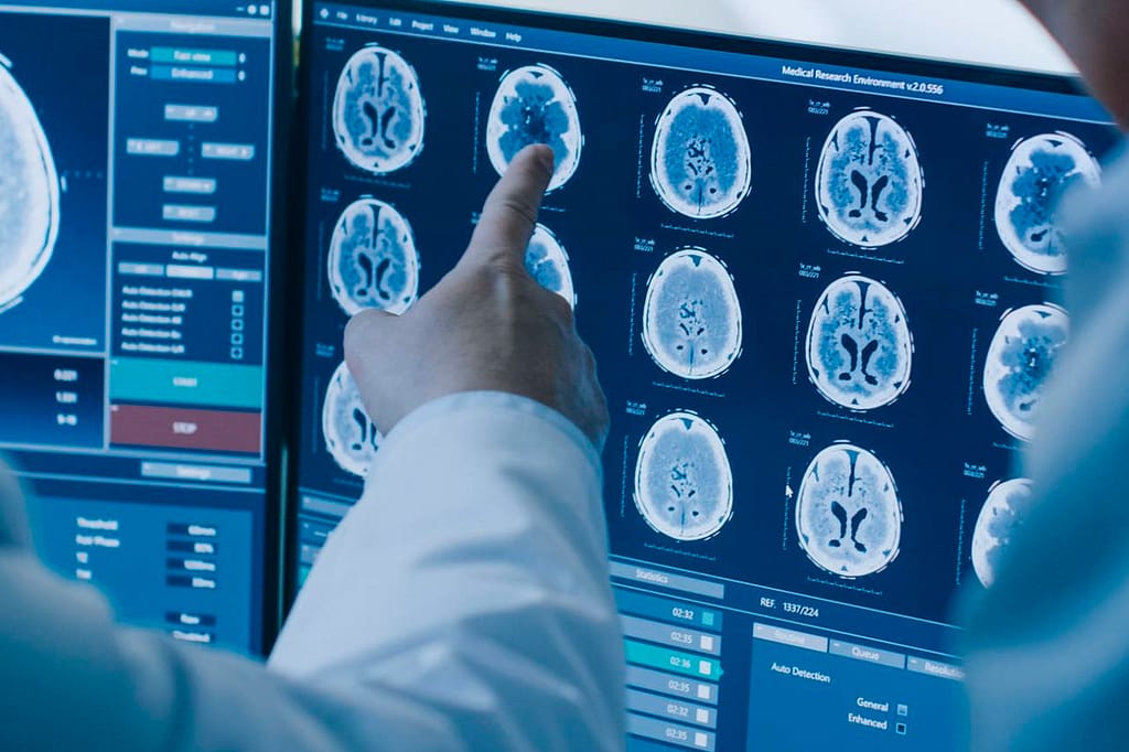 Os benefícios da Graviola Prozono para o tratamento do câncer BRCA1-2 negativo e sem proteína pdl1 com metástase