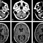 Tratamento Natural de Melanoma Cerebral em Estágio 4 com Metástase
