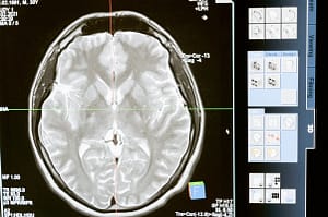 wie-man-die-ergebnisse-der-strahlentherapie-mit-weniger-nebenwirkungen-verbessert