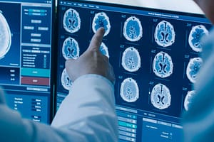 Os benefícios da Graviola Prozono para o tratamento do câncer BRCA1-2 negativo e sem proteína pdl1 com metástase