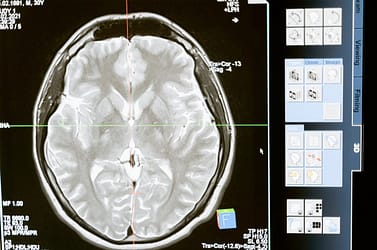 Como melhorar os resultados da radioterapia com menos efeitos colaterais