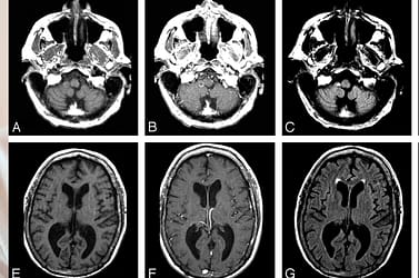 Tratamento Natural de Melanoma Cerebral em Estágio 4 com Metástase